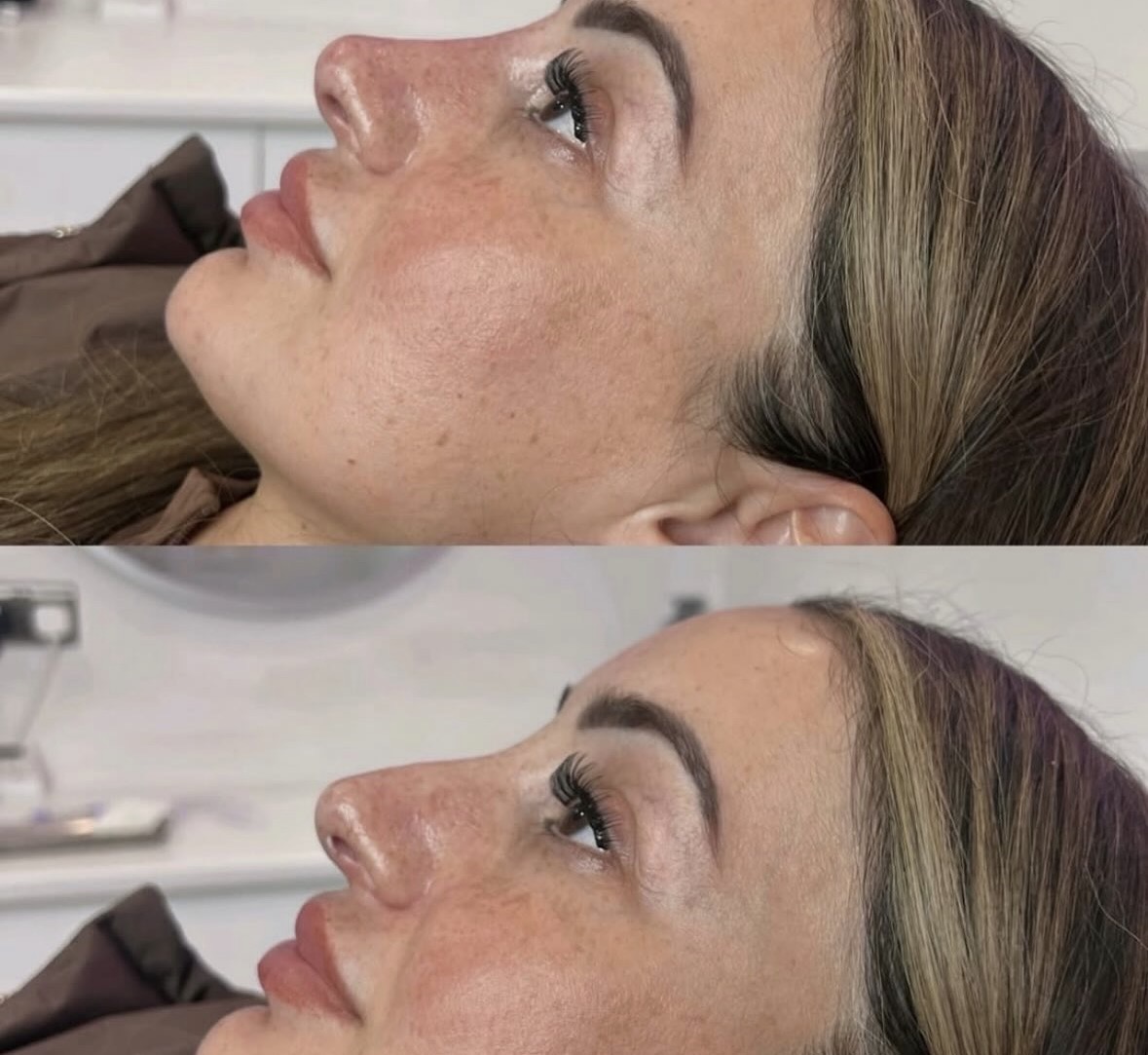 Rhinoplastie médicale