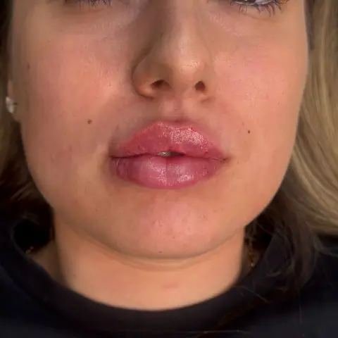 Volume des lèvres harmonisé — LIPS AESTHETICS PARIS