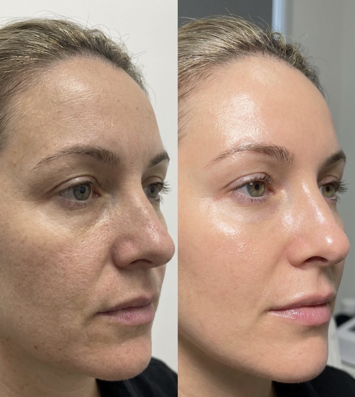 Soin Hydrafacial