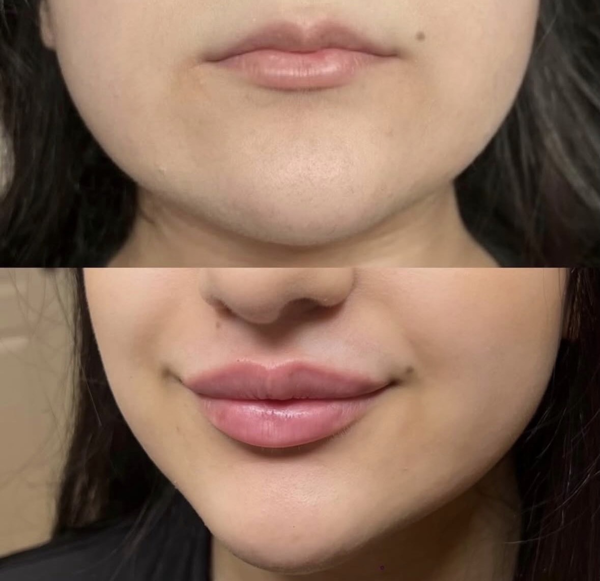 Résultat lèvres