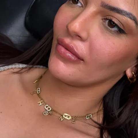 Résultat lèvres — filler acide hyaluronique, LIPS AESTHETICS PARIS