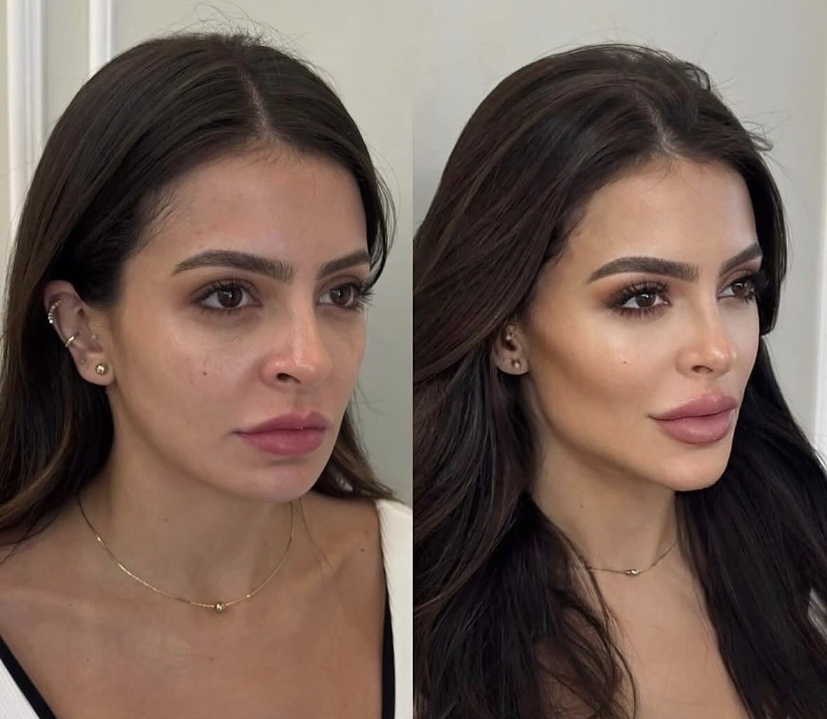 Résultat harmonisation du visage — LIPS AESTHETICS PARIS
