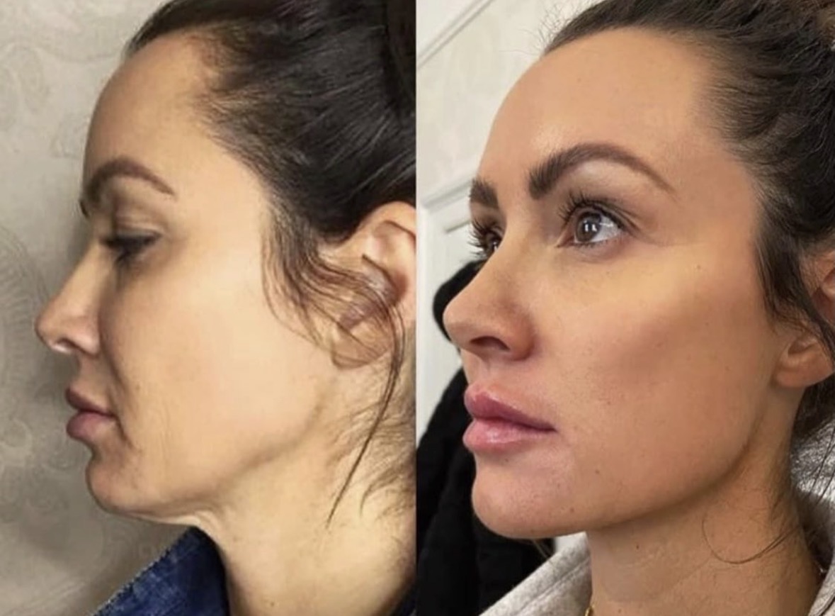 Jawline redéfinie